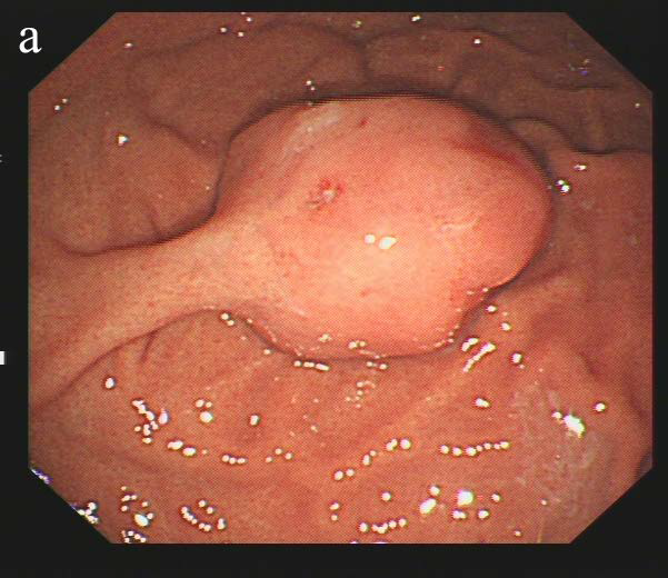 The endoscope shows a pedunculated lesion on the greater curvature of the gastric fundus, measuring about 2.4 cm in length, and the surface mucosa appears smooth (a). Endoscopic ultrasound shows a moderately hyperechoic nodule with a peduncle in the gastric fundus that has a smooth, intact capsule
