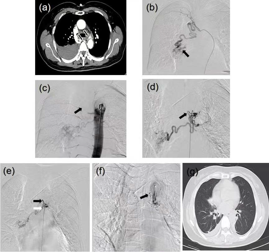 BAE treatment for RHBA. (A) Initial contrast-enhanced thoracic CT: Hyperdense right pleural effusion (41-58 HU) in posterior mediastinum and right hemithorax. Tortuous, dilated, and disorganized vascular structures in posterior mediastinum and right hilum. (B) DSA: Long-segment aneurysmal dilatation of right bronchial artery. Terminal contrast extravasation with disorganized vascular bed. (C) Postembolization thoracic aortography (subtraction technique): Proximal coil embolization of superior RHBA. Two persistent hypertrophied bronchial arteries supplying hemorrhage territory. (D) Embolization of inferior RHBA: Proximal coil deployment with gelatin sponge augmentation. Visible communicating branch (arrowhead). (E) Post-communicating branch embolization: Coil occlusion of communicating branch (white arrow). Abnormal vascular blush in middle RHBA (black arrow). (F) Final embolization outcome: Proximal coil deployment in middle RHBA. "Stumplike" occlusion of all three RHBAs. Complete resolution of abnormal vascular blush.(G) 12-day follow-up non-contrast CT: Interval resolution of bilateral pulmonary opacities. Significant reduction in right pleural effusion. Improved re-expansion of right lower lobe.
