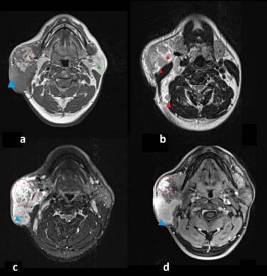 A 47-year-old man with a painless, slowly enlarging mass in the right parotid region. Kimura’s disease. Multiparametric MRI of the neck. (a) Axial T1-weighted image demonstrates a subcutaneous periauricular lesion (blue triangle) with slightly increased signal intensity relative to adjacent muscle and poorly defined margins. An intraparotid lymph node (red circle) shows lower signal intensity relative to the surrounding parotid parenchyma (green triangle). (b) Axial T2-weighted image shows a heterogeneous signal intensity, including relatively low T2 signal, associated with intraparotid and lateral cervical lymphadenopathies (red triangles). (c) Axial dynamic contrast-enhanced fat-suppressed T1- weighted gradient-echo image (VIBE) demonstrates early and progressive enhancement of the lesion (blue triangle), without significant washout, consistent with an inflammatory pattern, and showing subtle internal signal voids suggesting vascularity. The intraparotid lymph node (red circle) shows early enhancement.. (d). Axial fat-suppressed T1-weighted spin-echo image shows relatively homogeneous enhancement of the lesion (blue triangle). The intraparotid lymph node (red circle) also demonstrates homogeneous enhancement. Technique: MRI was performed on a 1.5-T scanner using two-dimensional axial T1-weighted spin-echo sequences (slice thickness 3 mm), highresolution T2-weighted turbo spin-echo sequences, dynamic contrast-enhanced fat-suppressed T1-weighted sequences (VIBE), and fat-suppressed T1-weighted spin-echo sequences after intravenous administration of gadoteridol (ProHance®, 16 mL; injection rate 2.0 mL/s)