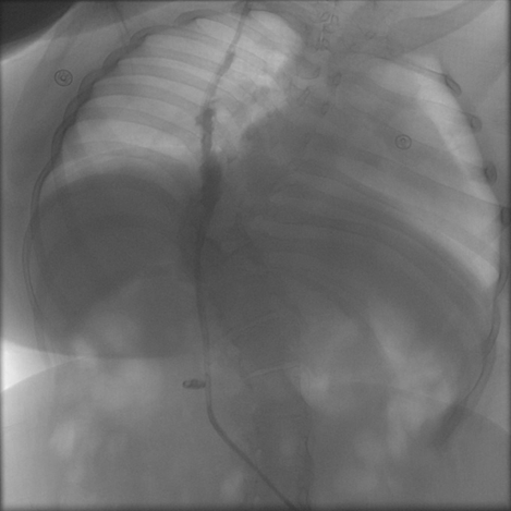 (A) Chest X-ray and (B) pelvic X-ray demonstrating contrast opacification of the ventriculoperitoneal (VP) shunt catheter along its expected course. The shunt system is visualized on both images without radiographic evidence of disconnection on the shunt series