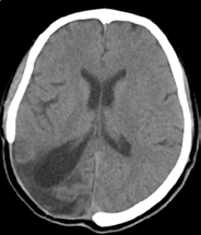 Postoperative imaging findings following surgical drainage of brain abscess.