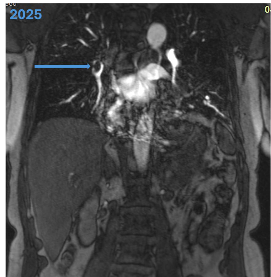 65-year-old female with right-sided PE