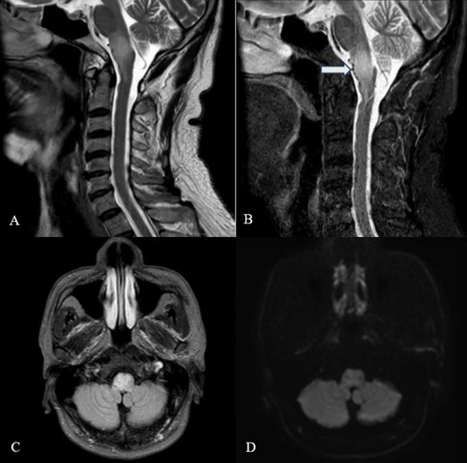 62-year-old male patient with Cognard type V dAVF: MRI findings at admission. (A), (B): Sagittal T2-Weighted (A) and STIR (B) images show a hyperintense lesion in the medulla oblongata and upper cervical spinal cord at C1-C2, with several small flow voids representing dilated vessels along the anterior surface of the medulla (large white arrows), which were initially overlooked. (C), (D): Axial FLAIR images show hyperintensity without diffusion restriction on DWI
